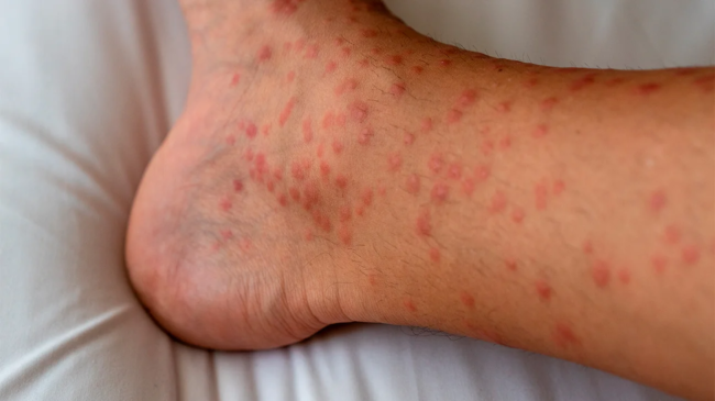 Milialar eczema